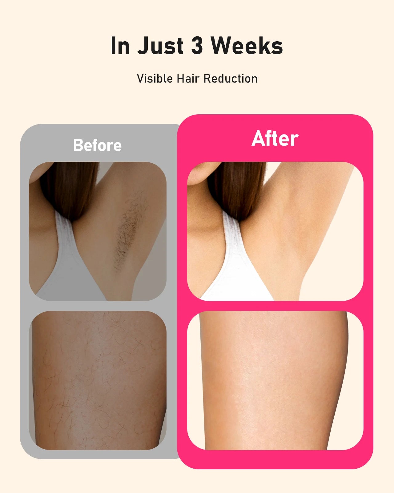 JOOYEE IPL Laser Hair Removal Epilator 3 Modes for Body